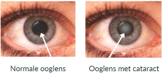 Annick Scholliers - Voluit Keto - cataract glycatie 2